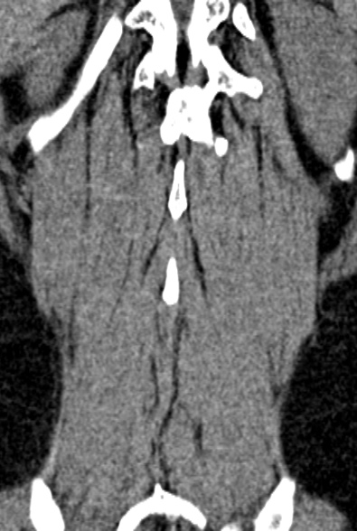 Normal CT lumbar spine (Radiopaedia 53981-60118 F 86).jpg