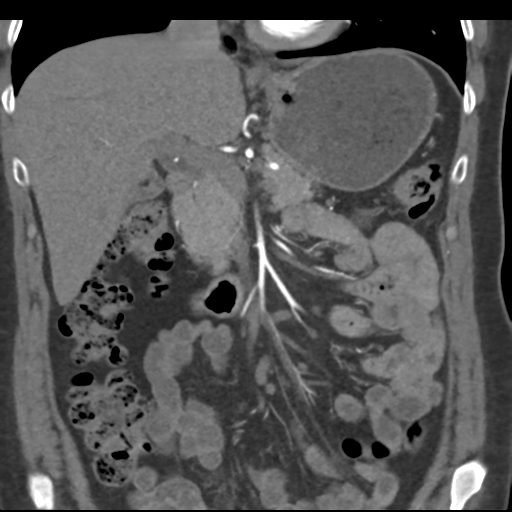 File:Normal CT renal artery angiogram (Radiopaedia 38727-40889 B 32).png