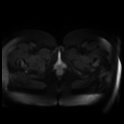 Normal MRI abdomen in pregnancy (Radiopaedia 88005-104548 Axial DWI 37).jpg