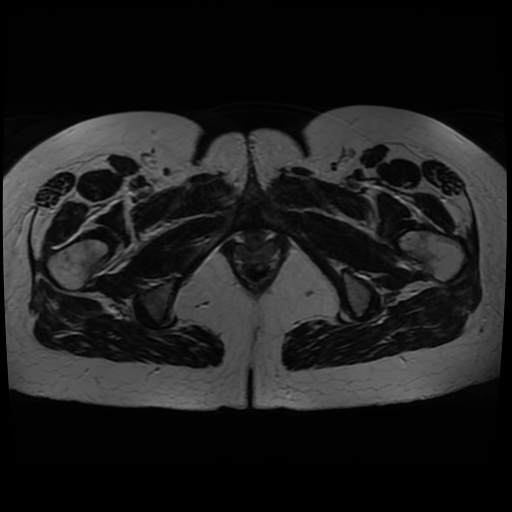 Normal MRI abdomen in pregnancy (Radiopaedia 88005-104548 Axial T2 48).jpg