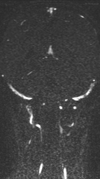 Normal MRI brain with MRV- teenager (Radiopaedia 49425-54553 Coronal MRV 163).jpg