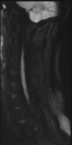 File:Normal MRI cervical spine (infection protocol) (Radiopaedia 53916-60039 Sagittal DWI 19).png