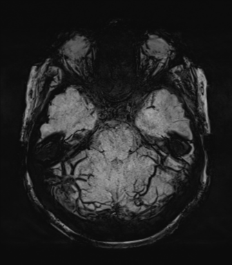 Normal MRI internal auditory canal (Radiopaedia 41613-44525 Axial SWI MIP 24).png