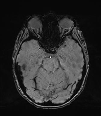 Normal brain MRI (TLE protocol) (Radiopaedia 40748-43405 Axial SWI 30).png