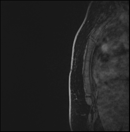 Normal breast MRI - dense breasts (Radiopaedia 80454-93850 I 188).jpg