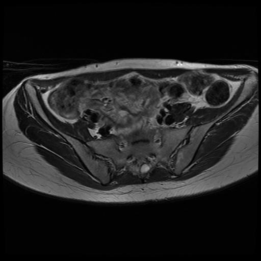 File:Normal female pelvis MRI (retroverted uterus) (Radiopaedia 61832-69933 Axial T2 9).jpg