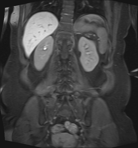 File:Normal hepatobiliary phase liver MRI (Radiopaedia 58968-66230 B 13).jpg