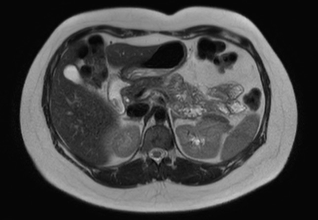 File:Normal liver MRI with Gadolinium (Radiopaedia 58913-66163 Axial T2 18).jpg