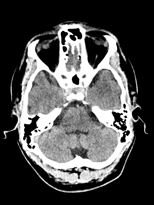 Normal trauma protocol brain and C-spine CT (Radiopaedia 83302-97709 Axial non-contrast 54).jpg