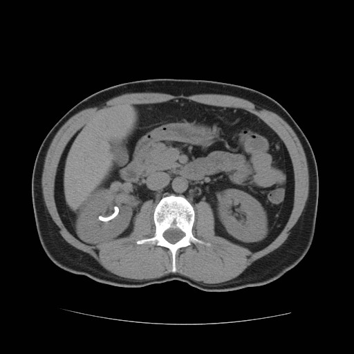 File:Obstructed kidney with perinephric urinoma (Radiopaedia 26889-27067 Axial non-contrast 10).jpg