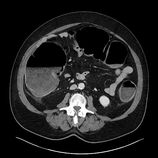 Obstructing sigmoid adenocarcinoma (Radiopaedia 58465-65619 A 86).jpg