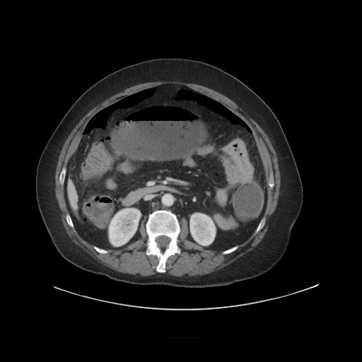 Obstructive distal colonic adenocarcinoma causing cecal perforation (Radiopaedia 86830-102989 A 90).jpg