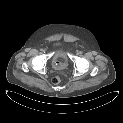 File:Obstructive pyelonephritis (Radiopaedia 46411-50844 Axial non-contrast 73).png