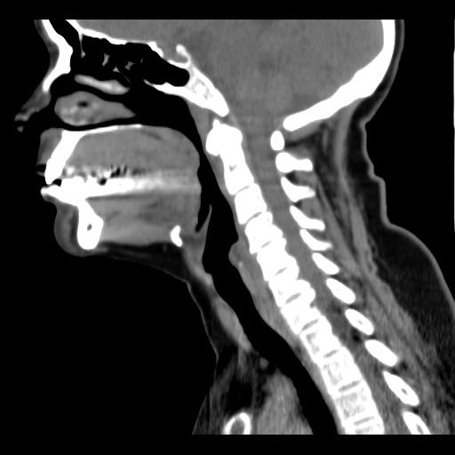 File:Obstructive sleep apnea (CT evaluation) (Radiopaedia 24304-24582 C 39).jpg