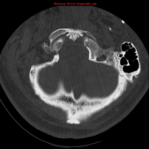 File:Occipital condyle fracture (Radiopaedia 18366-18208 Axial bone window 12).jpg