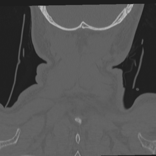 File:Occipital condyle fracture (Radiopaedia 33467-34517 Coronal bone window 68).png
