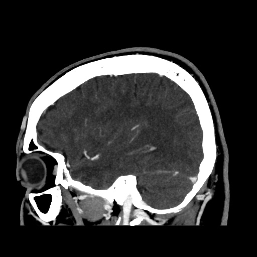 Occipital extradural hematoma simulating venous sinus thrombosis (Radiopaedia 46514-50964 D 22).jpg