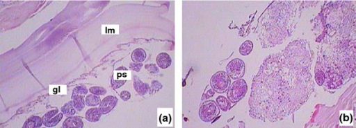 a,b)Surgical pathology of the cystic echinococcosis