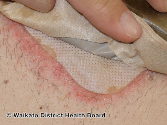 File:Stoma dermatitis (DermNet NZ irritant-contact-dermatitis-003).jpg
