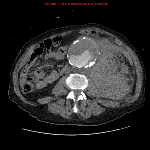 Abdominal aortic aneurysm- extremely large, ruptured (Radiopaedia 19882-19921 Axial C+ arterial phase 40).jpg