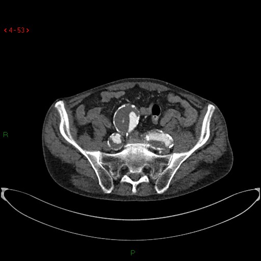 File:Abdominal aortic aneurysm (Radiopaedia 16155-15834 Axial C+ arterial phase 33).jpg