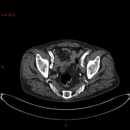 File:Abdominal aortic aneurysm (Radiopaedia 16155-15834 Axial C+ arterial phase 42).jpg