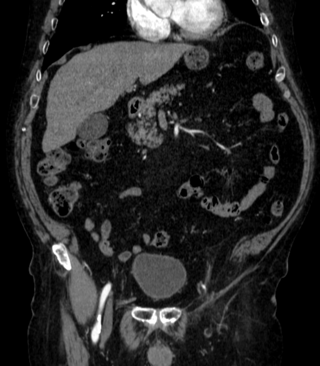 Abdominal aortic aneurysm (Radiopaedia 25855-26001 Coronal C+ arterial phase 14).jpg