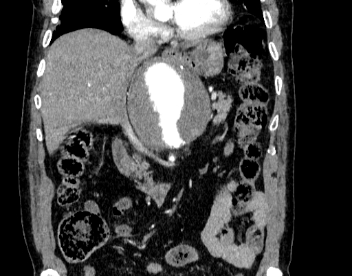 File:Abdominal aortic aneurysm (Radiopaedia 67117-76452 Coronal C+ arterial phase 38).jpg