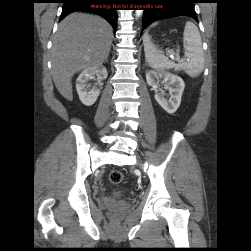Abdominal aortic aneurysm (Radiopaedia 8190-9038 Coronal C+ arterial phase 86).jpg