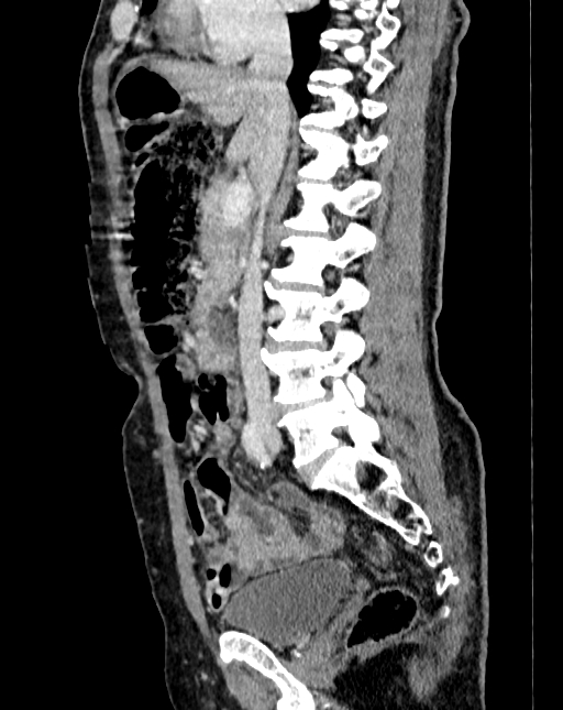 Abdominal aortic aneurysm (Radiopaedia 83581-98689 Sagittal C+ portal venous phase 36).jpg