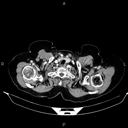 File:Abdominal aortic aneurysm (Radiopaedia 85063-100606 Axial C+ portal venous phase 5).jpg
