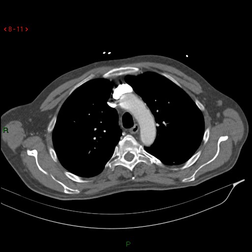 Abdominal aortic aneurysm rupture with aortocaval fistula (Radiopaedia 14897-14841 Axial C+ arterial phase 11).jpg
