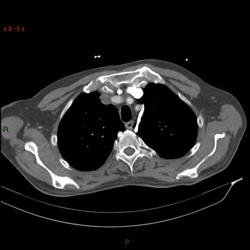 Abdominal aortic aneurysm rupture with aortocaval fistula (Radiopaedia 14897-14841 Axial C+ arterial phase 5).jpg