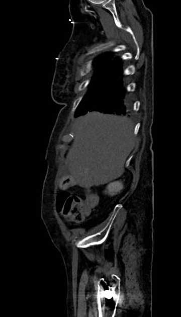 Abdominal aortic aneurysm with thrombus fissuration (Radiopaedia 73192-83919 Sagittal C+ arterial phase 124).jpg