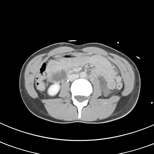 File:Abdominal multi-trauma - devascularised kidney and liver, spleen and pancreatic lacerations (Radiopaedia 34984-36486 Axial C+ delayed 40).png