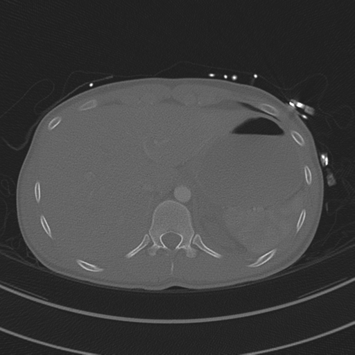 File:Abdominal multi-trauma - devascularised kidney and liver, spleen and pancreatic lacerations (Radiopaedia 34984-36486 I 80).png