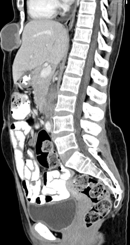 Abdominal wall and retroperitoneal tuberculosis (Radiopaedia 88137-104729 Sagittal C+ portal venous phase 78).jpg
