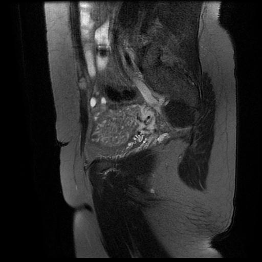 File:Abdominal wall endometriosis (Radiopaedia 83702-98847 Sagittal T2 fat sat 13).jpg