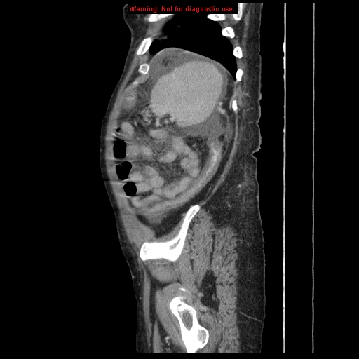 Abdominal wall hematoma (Radiopaedia 9427-10112 Sagittal C+ portal venous phase 20).jpg