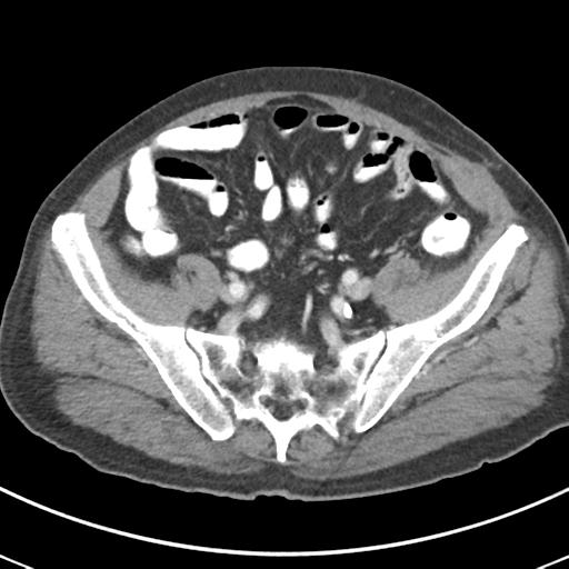 Abdominal wall metastasis from colorectal carcinoma (Radiopaedia 31016-31717 Axial C+ portal venous phase 58).jpg