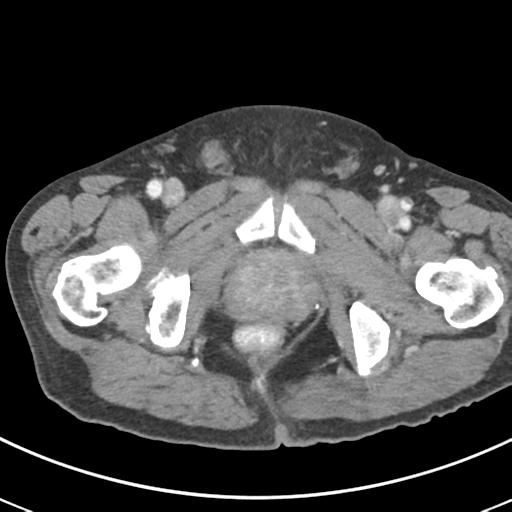 Abdominal wall metastasis from colorectal carcinoma (Radiopaedia 31016-31717 Axial C+ portal venous phase 78).jpg