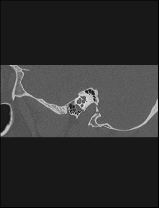 Aberrant right internal carotid artery (Radiopaedia 65191-74198 Sagittal non-contrast 55).jpg