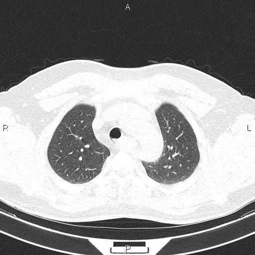 Aberrant right subclavian artery (Radiopaedia 87093-103354 Axial lung window 26).jpg