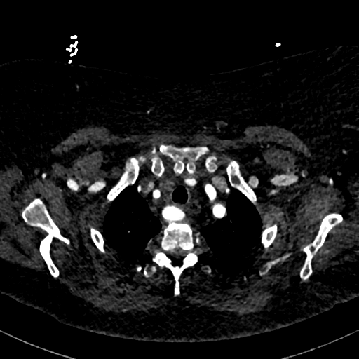 Aberrant right subclavian artery with Kommerell diverticulum (Radiopaedia 47982-52769 Axial C+ arterial phase 16).png