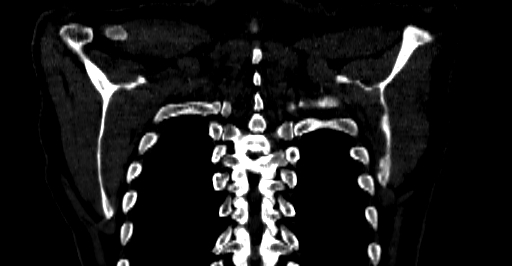 Accesory rib joint (Radiopaedia 71987-82452 Coronal bone window 69).jpg