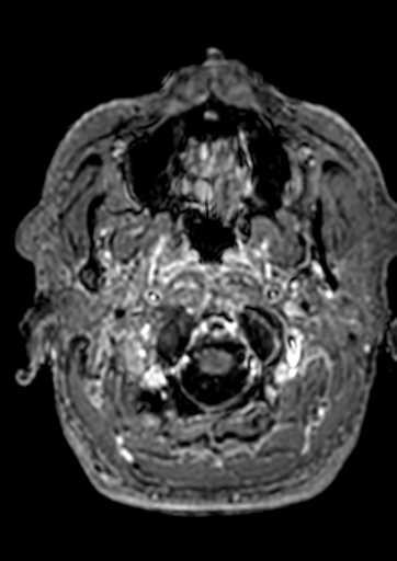 File:Accessory middle cerebral artery (Radiopaedia 73114-83828 Axial T1 C+ 194).jpg