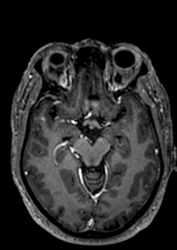 Accessory middle cerebral artery (Radiopaedia 73114-83828 Axial T1 C+ 69).jpg