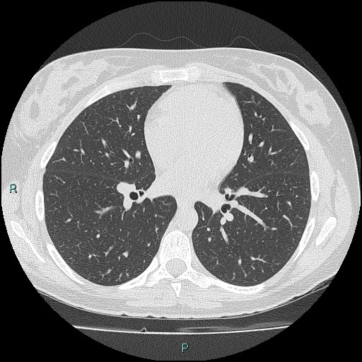 Accidental foreign body aspiration (seamstress needle) (Radiopaedia 77740-89983 Axial lung window 37).jpg
