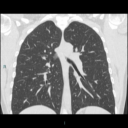 Accidental foreign body aspiration (seamstress needle) (Radiopaedia 77740-89983 Coronal lung window 24).jpg