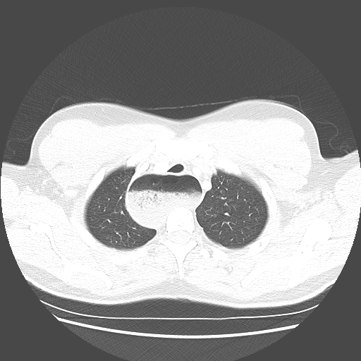 Achalasia (Radiopaedia 52507-58417 Axial lung window 11).jpg
